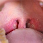 tonsil throat,Oral tonsil