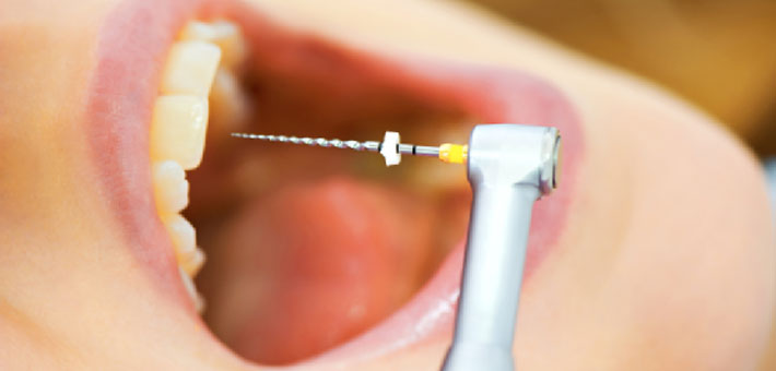 shocking-connection-97-percent-terminal-cancer-patients-previously-had-root-canal-procedure-fb